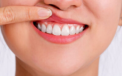 How Can I Defend Against Gum Recession?