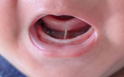 The Tongue Tie Dentist: Easy Treatment With Big Results